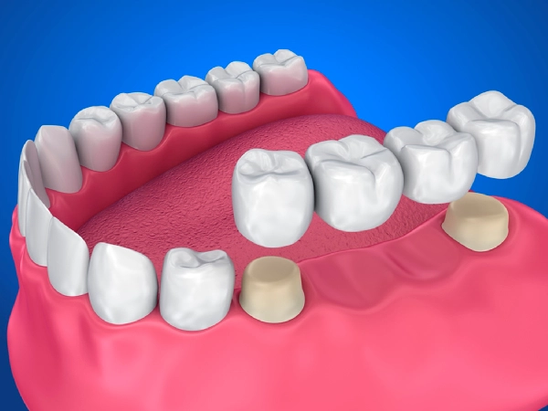Dental Bridges