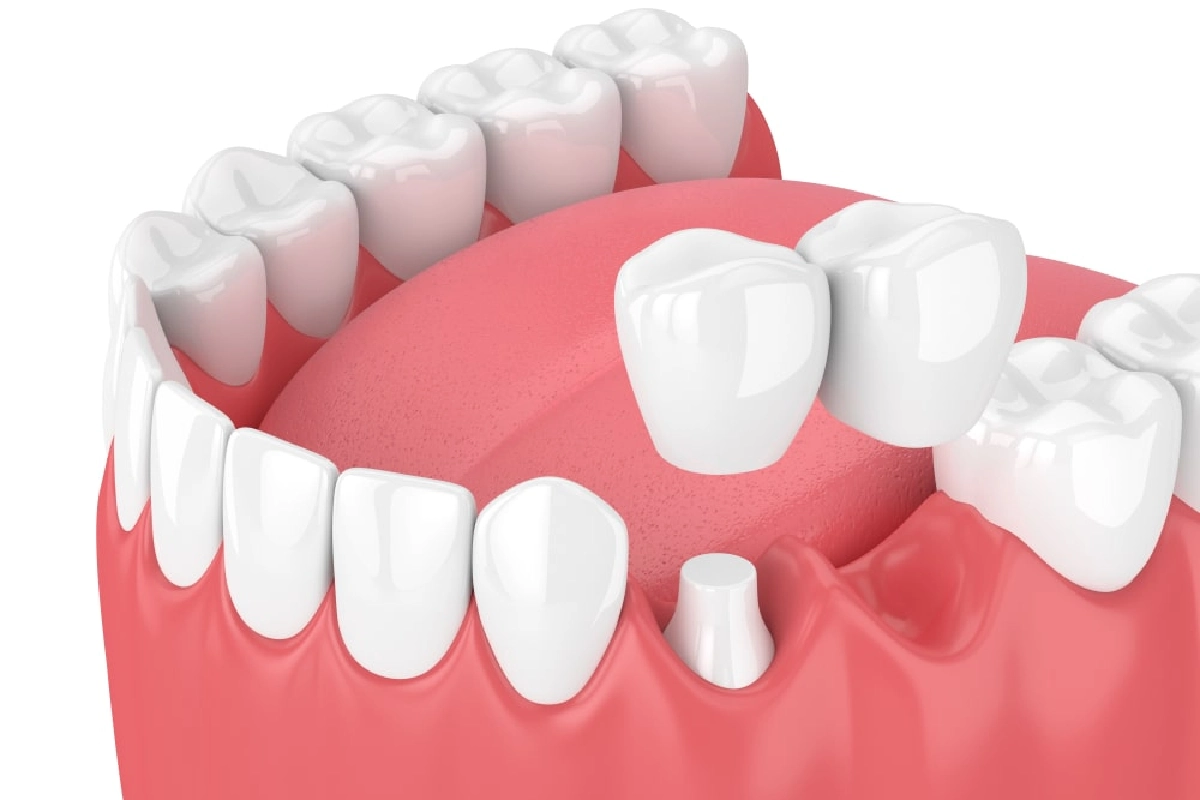Dental Bridges