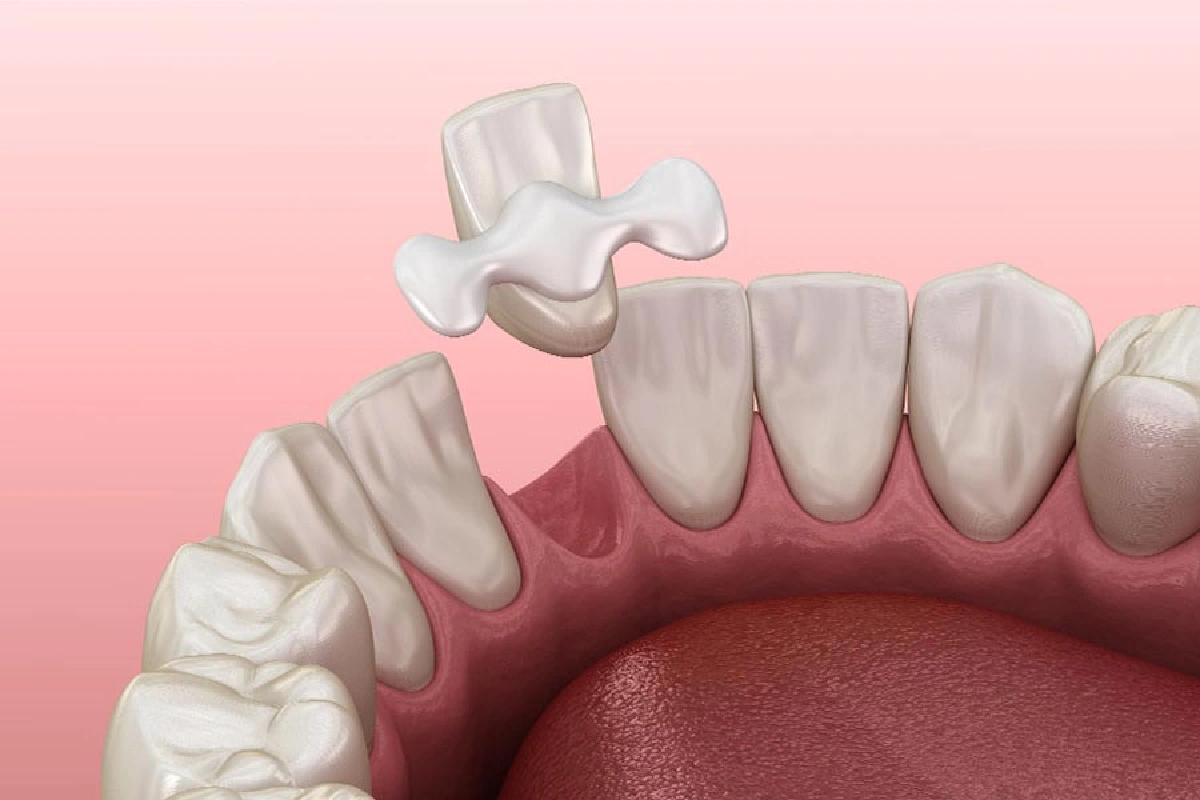 Dental Bridges