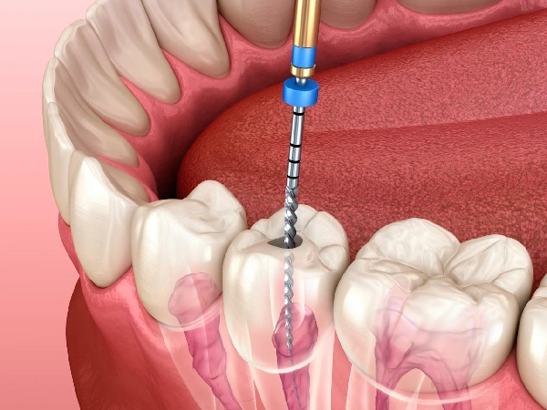 Root Canal