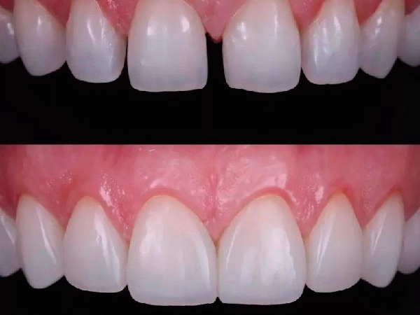 Composite Bonding