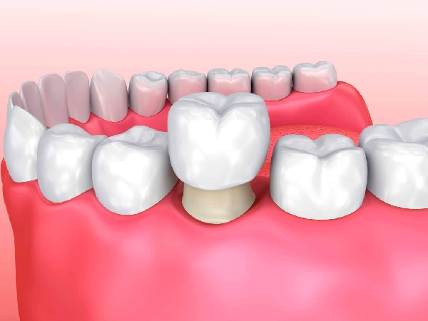 Dental Crowns