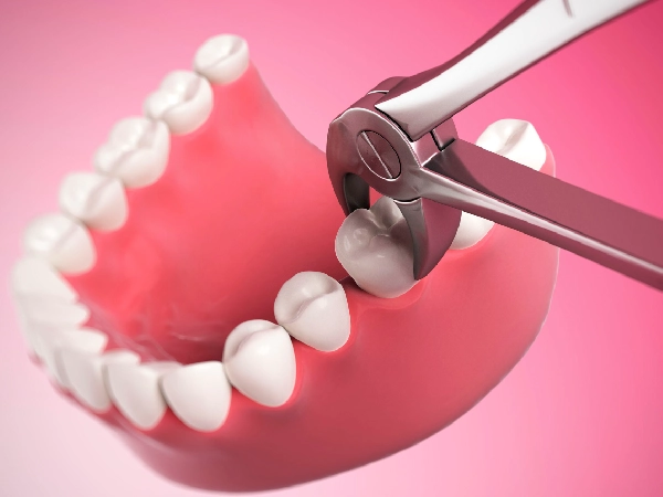 Extractions