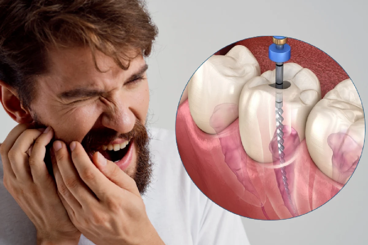 Root Canal Treatment