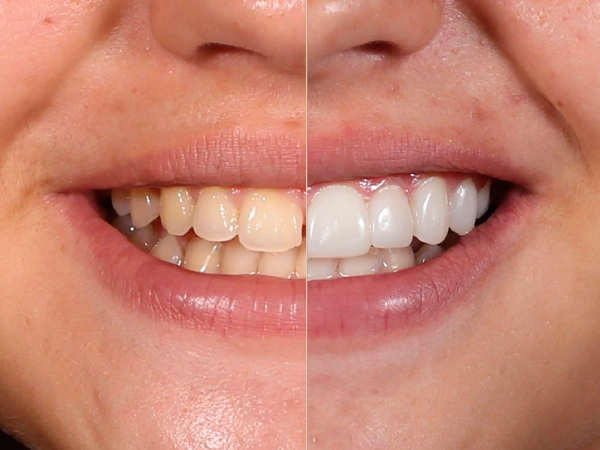 Smile Makeover