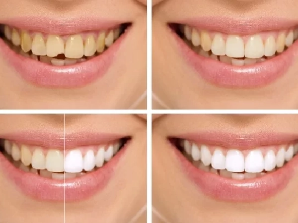 Smile Design