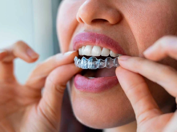 Teeth Straightening