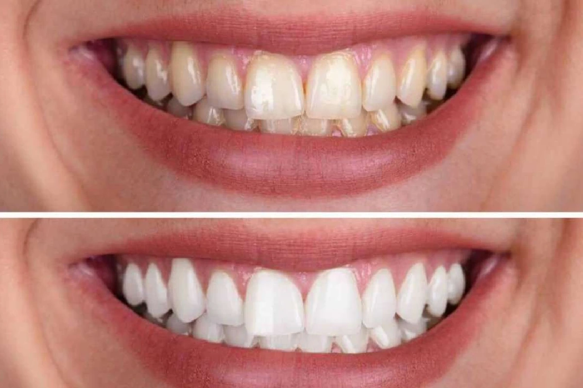 Enlighten Whitening