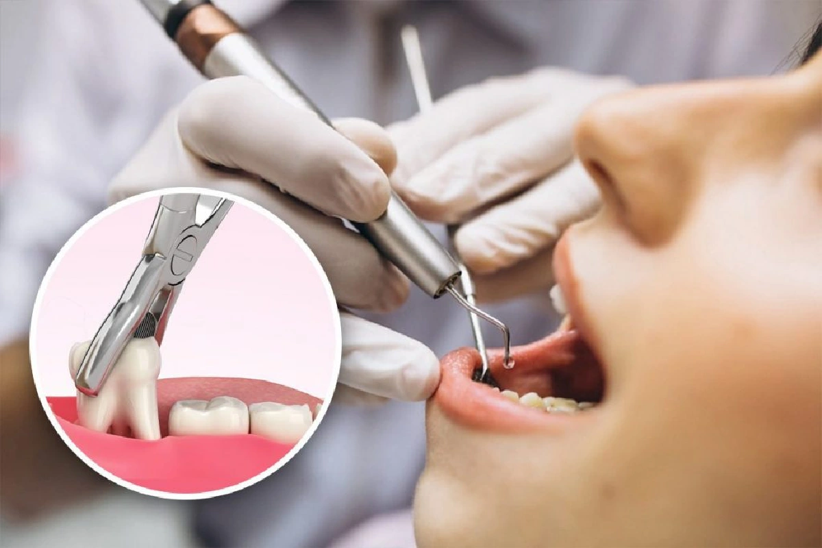 Tooth Extractions